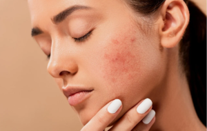 Beat skin breakouts with homeopathy