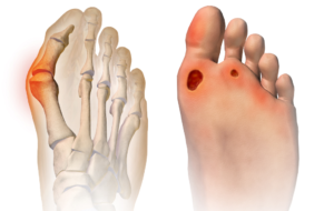 How Can Foot Ulcers Be Treated?