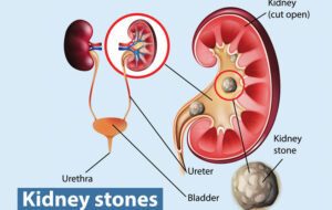 Is Vitamin C a Risk Factor for Kidney Stones?