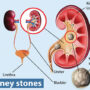 Is Vitamin C a Risk Factor for Kidney Stones?