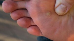 How can you prevent foot warts? Check out the points now!
