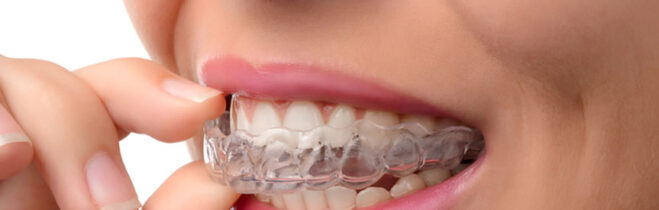 Are There Any Disadvantages of Having Braces?