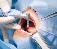 Pulpotomy in Powell, TN: Navigating a Tooth-Saving Procedure