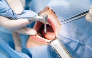 Pulpotomy in Powell, TN: Navigating a Tooth-Saving Procedure
